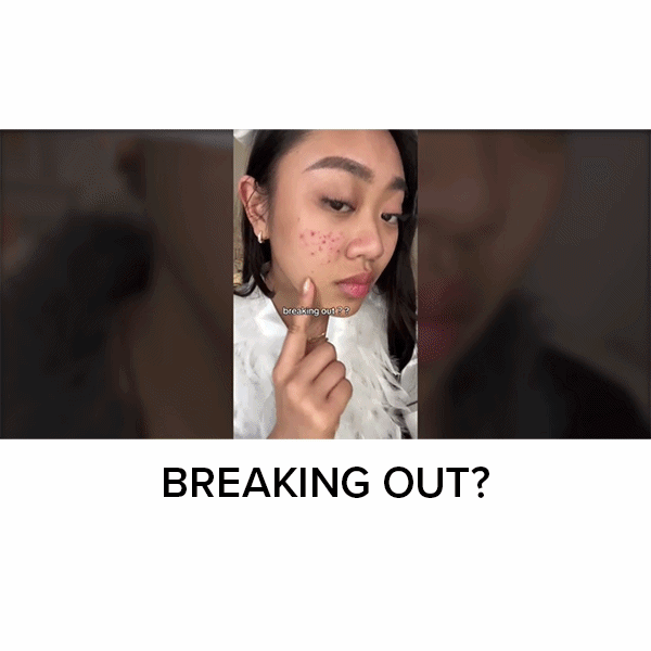 A person points to acne on their cheek with the text breaking out? overlaid, illustrating the need for Dr. Leo Acne Buster spot treatment.