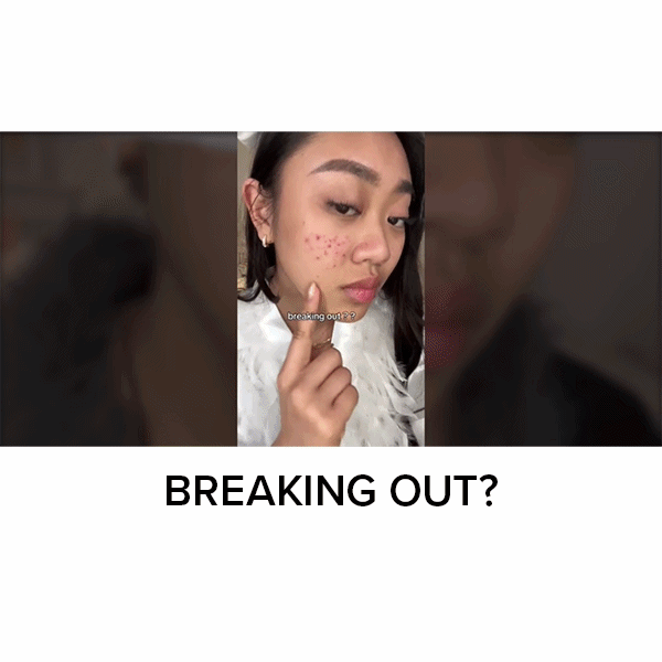 A person points to acne on their cheek with the text breaking out? overlaid, illustrating the need for Dr. Leo Acne Buster spot treatment.