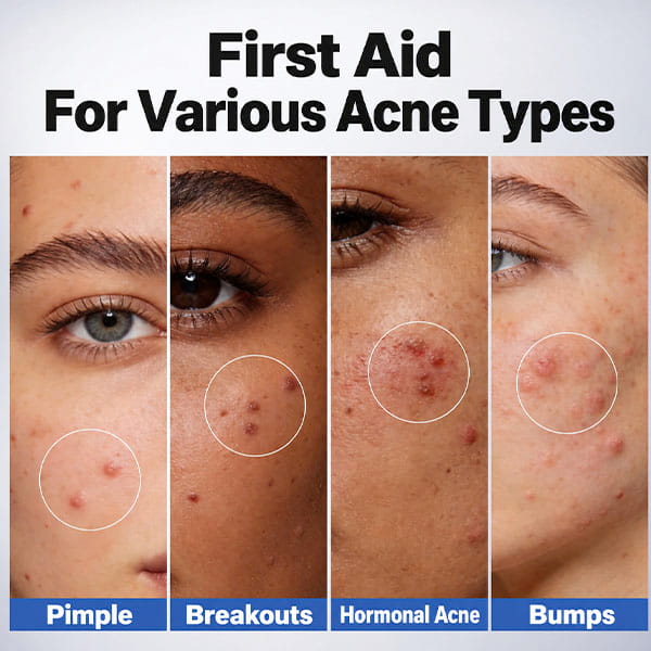 Four close-up images of skin showing pimples, hormonal acne, and breakouts, each labeled with its type to help guide your choice of Dr. Leo Acne Buster spot treatment.