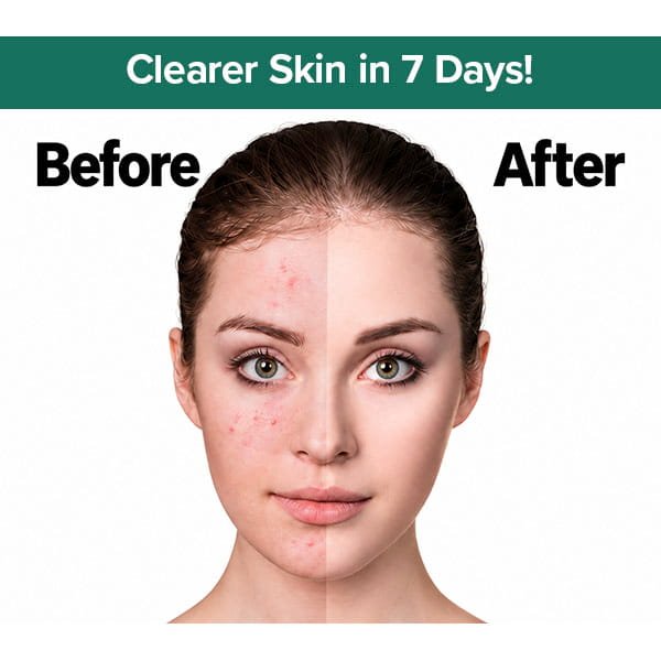 Before and after comparison of a person’s face using Dr. Leo Acne Buster, showing acne on the left and clear skin on the right, with the text Clearer Skin in 7 Days! above, highlighting the reduction of post-acne marks.