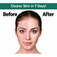 Before and after comparison of a person’s face using Dr. Leo Acne Buster, showing acne on the left and clear skin on the right, with the text Clearer Skin in 7 Days! above, highlighting the reduction of post-acne marks.