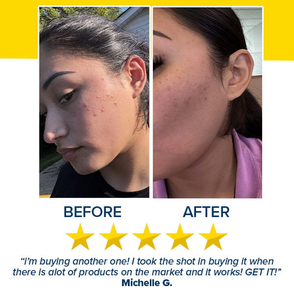 Before and after photos of a cheek showing a reduction in acne and post-acne marks after using Dr. Leo Acne Buster, accompanied by a five-star rating and a positive customer testimonial.