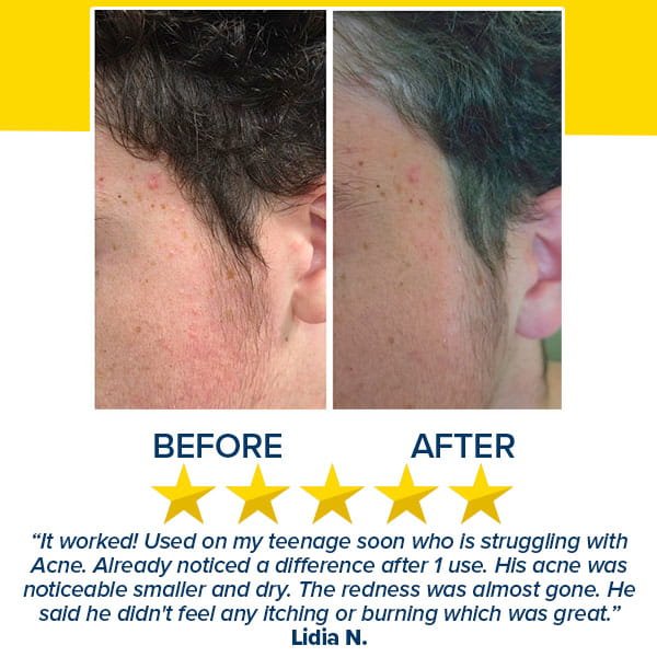 Before and after comparison of a cheek showing a reduction in post-acne marks and redness after using Dr. Leo Acne Buster, featuring a five-star rating and a customer review.