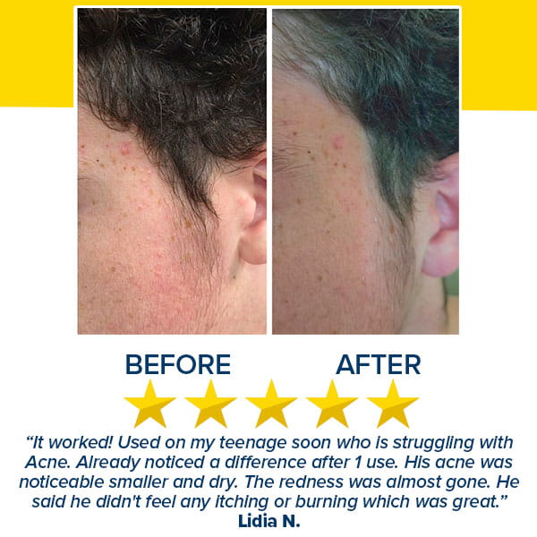 Before and after comparison of a cheek showing a reduction in post-acne marks and redness after using Dr. Leo Acne Buster, featuring a five-star rating and a customer review.