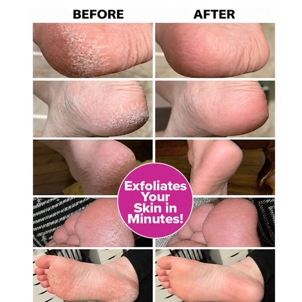 A series of before-and-after photos showing cracked feet transformed into smooth skin with Instant Foot Peeling Spray, featuring a circular label reading Exfoliates Your Skin in Minutes! in the center.