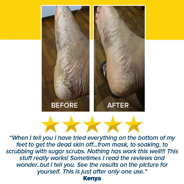 Before and after photos show cracked heels transformed to smooth skin, with a five-star review from Kenya praising the effective Instant Foot Peeling Spray.