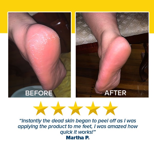 Two images show a foot before and after using Instant Foot Peeling Spray: the before foot is cracked, while the after appears smooth. Five stars and a customer testimonial are displayed below.