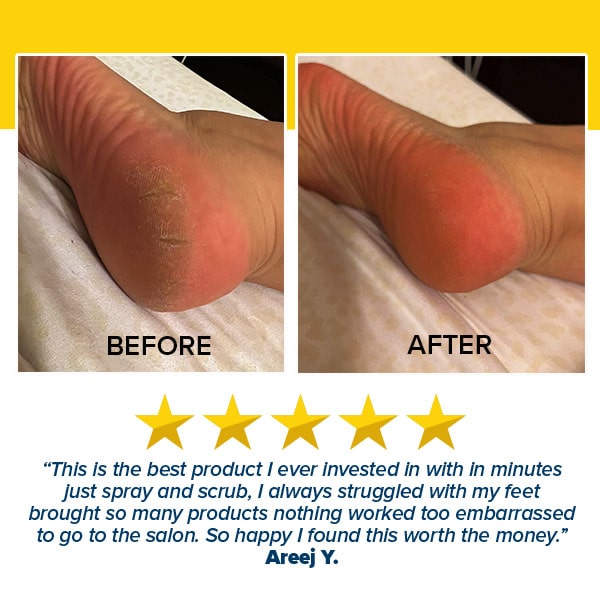 Before and after photos show cracked feet transformed to smooth skin using Instant Foot Peeling Spray; a five-star review and glowing testimonial highlight its effectiveness.