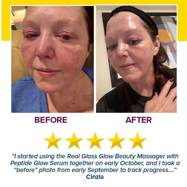 Side-by-side photos show a woman’s face before and after using the Real Glass Glow Beauty Massager: left—red, irritated skin; right—clearer, smoother skin. Five stars and a testimonial highlight improved pore care.