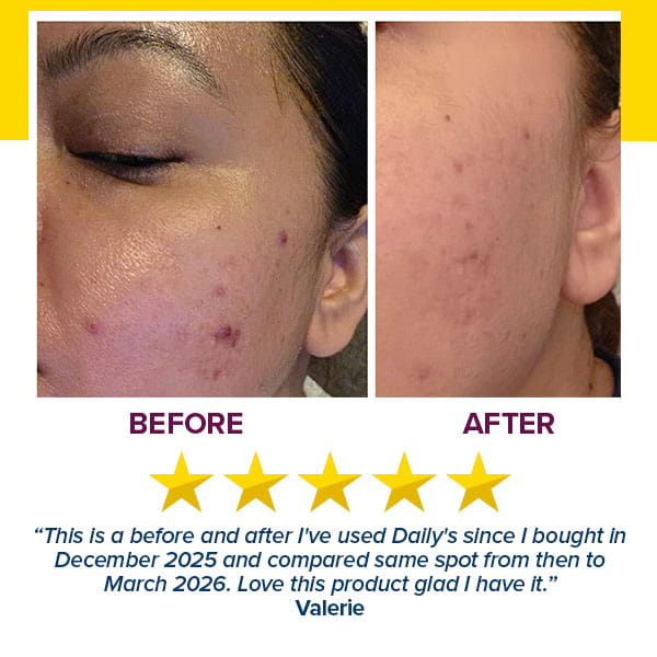 Side-by-side close-ups of a woman’s cheek reveal acne scar improvements before and after using the Real Glass Glow Beauty Massager, with five yellow stars, a glowing testimonial, and product dates showing visible pore care progress.